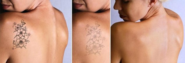 Laser Tattoo Removal Neutral Bay, Sydney | Tattoo Removal Specialists